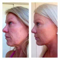Hawaii Injectable anti aging fillers or Natural